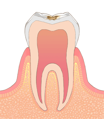 ②エナメル質の虫歯
