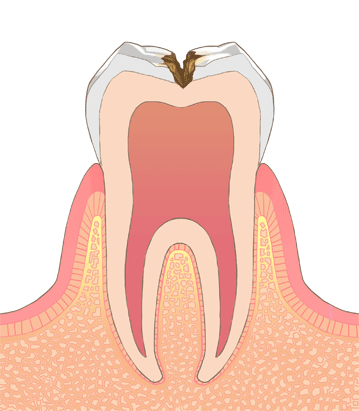 ③神経に近い虫歯