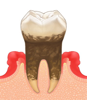 ④歯周炎（中度）